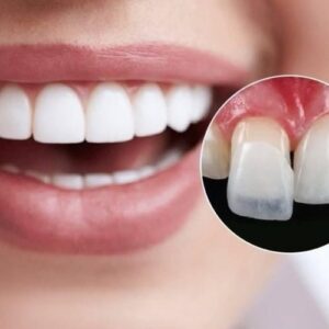 Dán sứ Veneer Emax