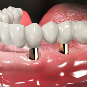 Hàm nhựa all on cố định