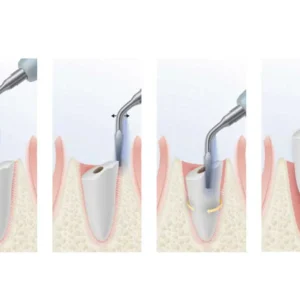 Nhổ răng bằng máy Piezotome