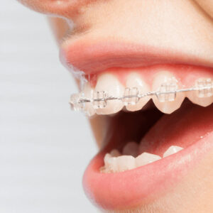 Mắc cài sứ tự buộc nong rộng