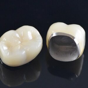 Sứ implant - kim loại Mỹ