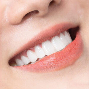 Sứ Orodent bảo hành 23 năm