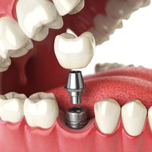 Implant Dentium Hàn Quốc