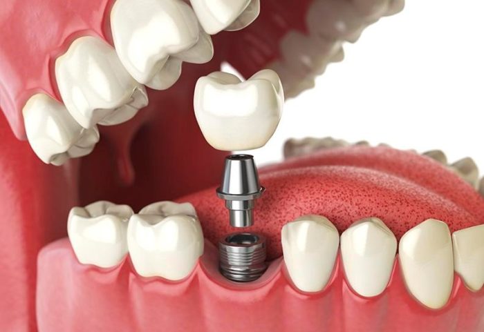 Implant Dentium Hàn Quốc